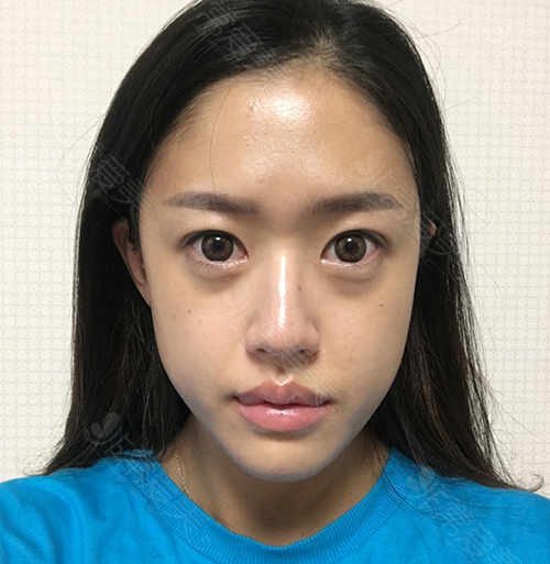 韩国EU整形医院双鄂手术术前照片 韩国EU整形医院双鄂手术术前照片