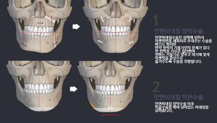 面部不对称矫正方法示意图 面部不对称矫正方法示意图