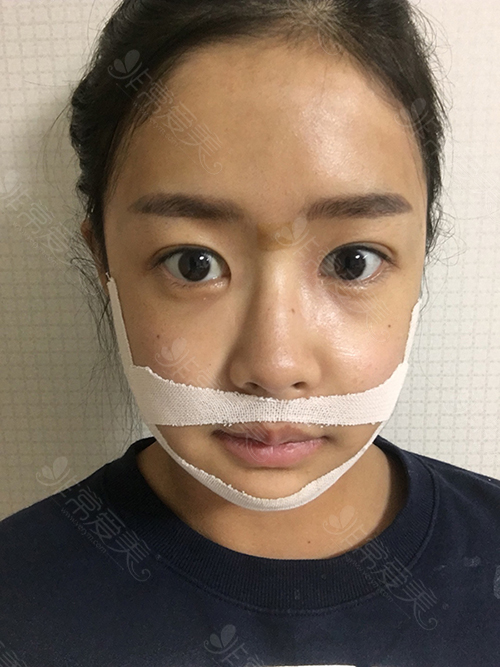 韩国EU整形医院双鄂整形术后照片 韩国EU整形医院双鄂整形术后照片