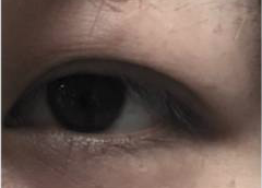 双眼皮肿眼泡形态 双眼皮肿眼泡形态