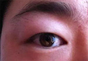 单眼皮肿眼泡形态 单眼皮肿眼泡形态