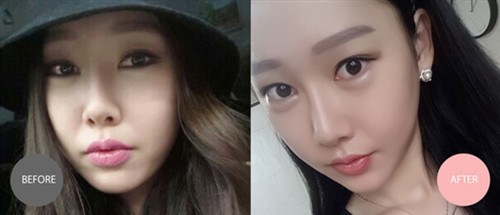 Faceplus轮廓手术真人案例 Faceplus轮廓手术真人案例